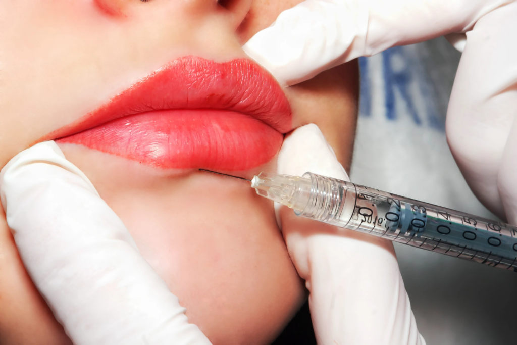 Get the Perfect Pout: Lip Fillers for a Glamorous Smile