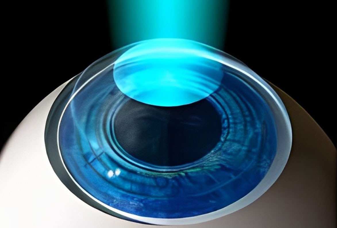 Enhancing Vision with Contoura Vision Eye Surgery
