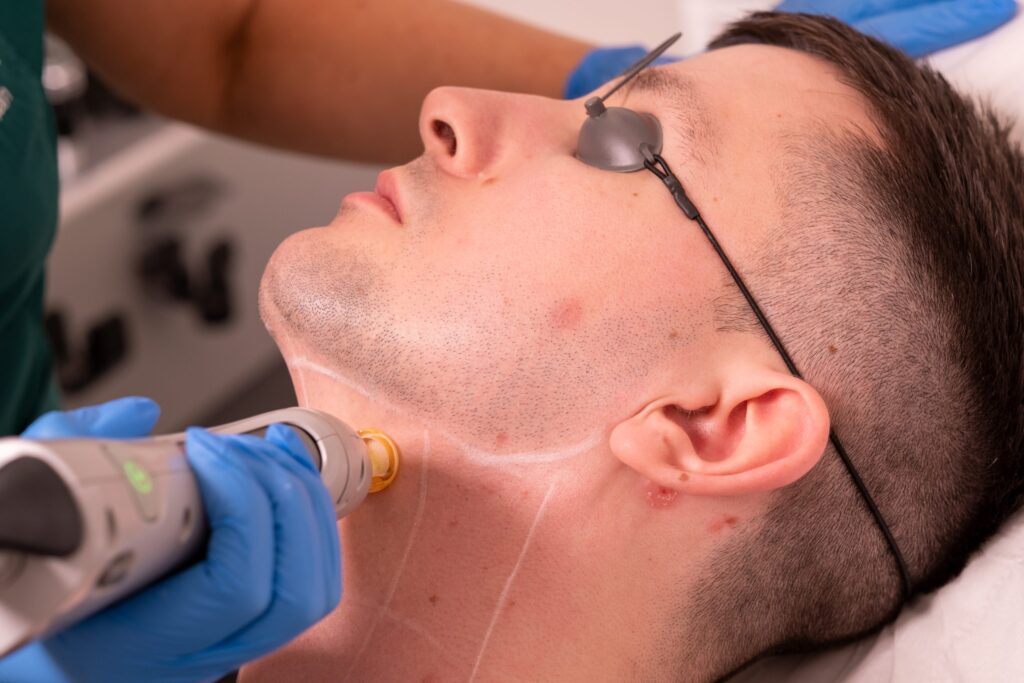 Best Laser Hair Removal Options for Dark Skin Tones