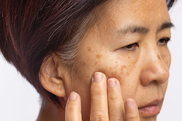 Best Practices for Treating Melasma and Achieving Even Skin