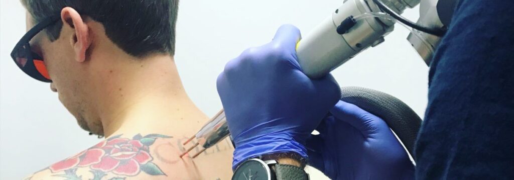 PicoSure: The Cutting-Edge Solution for Tattoo Removal Needs