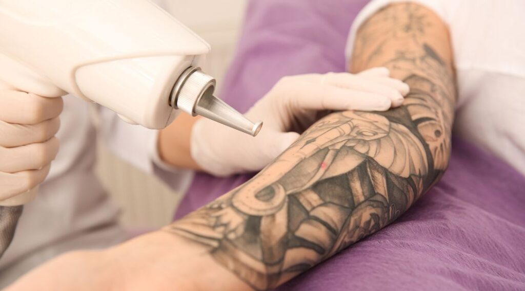Picosure Laser Tattoo Removal: Your Best Option Explained
