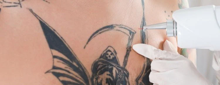 Tattoo-Free Skin in No Time: Picosure Laser Tattoo Removal