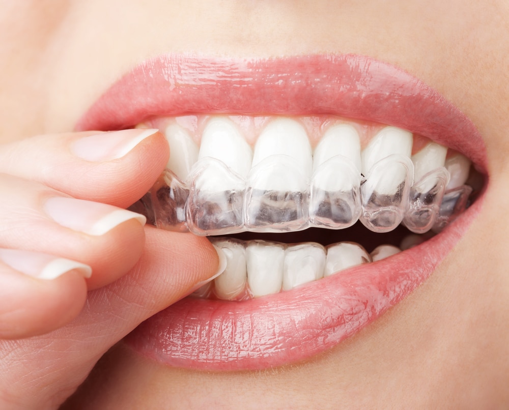Dubai’s Secret to a Celebrity-White Smile Revealed