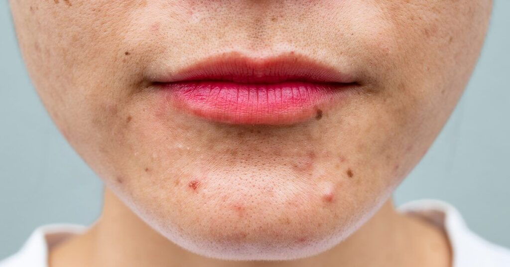 Selecting the Best Acne Treatment Based on Your Skin Type