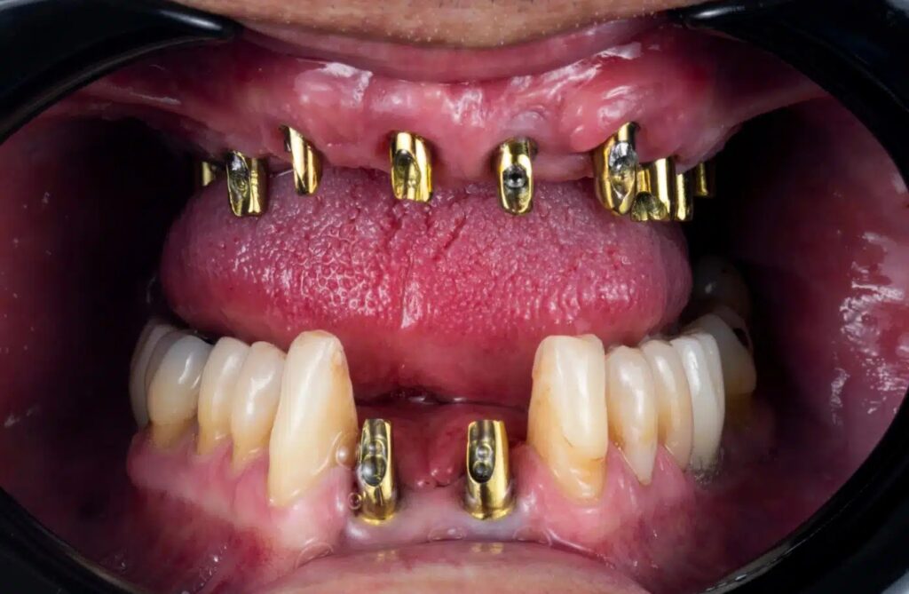Foods to Avoid for a Smooth Recovery After Dental Implant Surgery