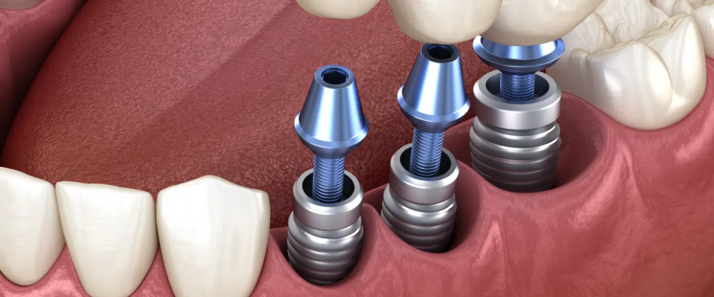 Implant