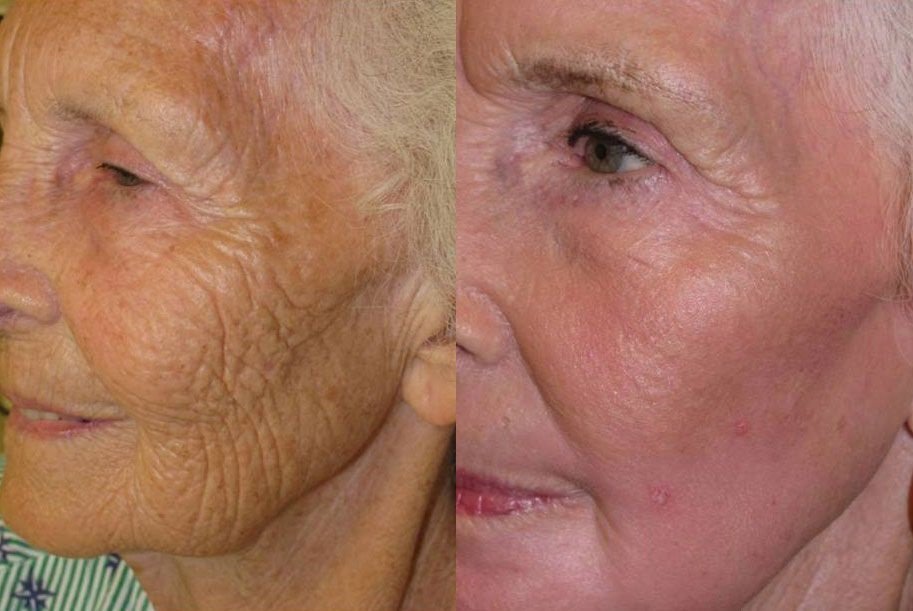 Glowing Skin Starts Here: Try Fractional CO2 Laser Today