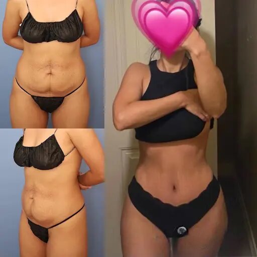 Tips for Choosing the Best Tummy Tuck Surgeon in dubai