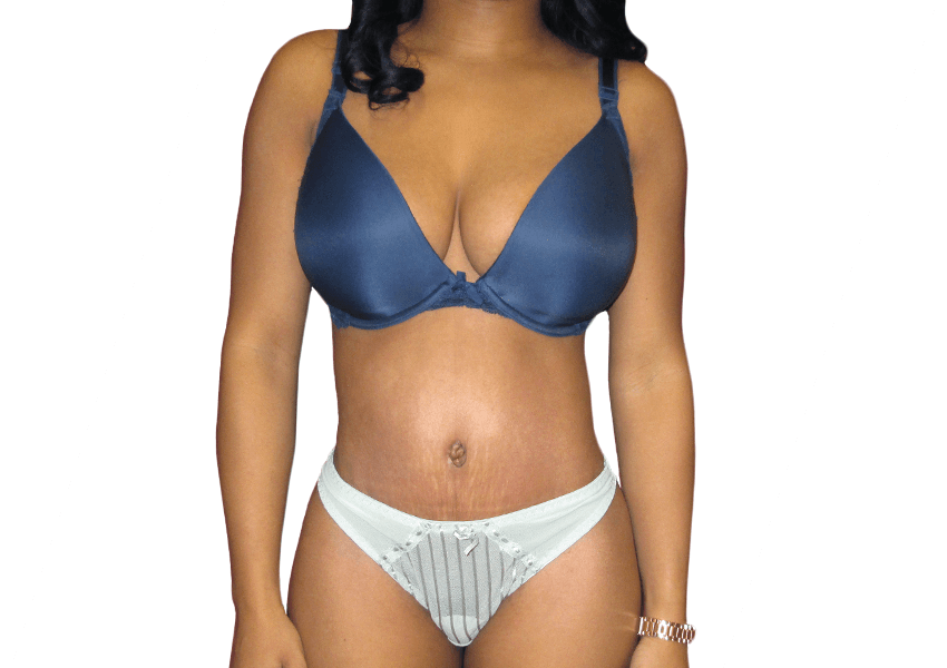 Is Liposuction the Best Option for Fat Removal?