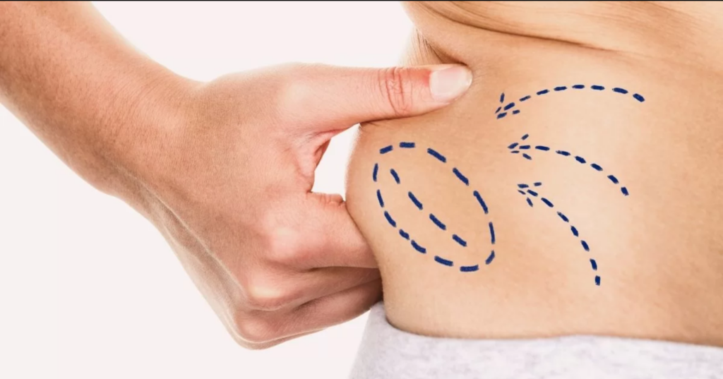 Compression Clothing Supports Liposuction Recovery in Dubai