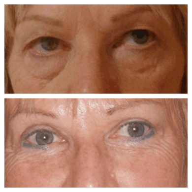 The Psychological Benefits of Eye bag removal Surgery in dubai