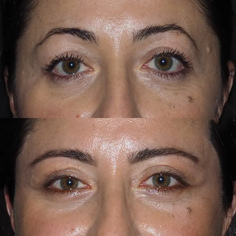 Can Men Get Eye bag removal in Dubai?