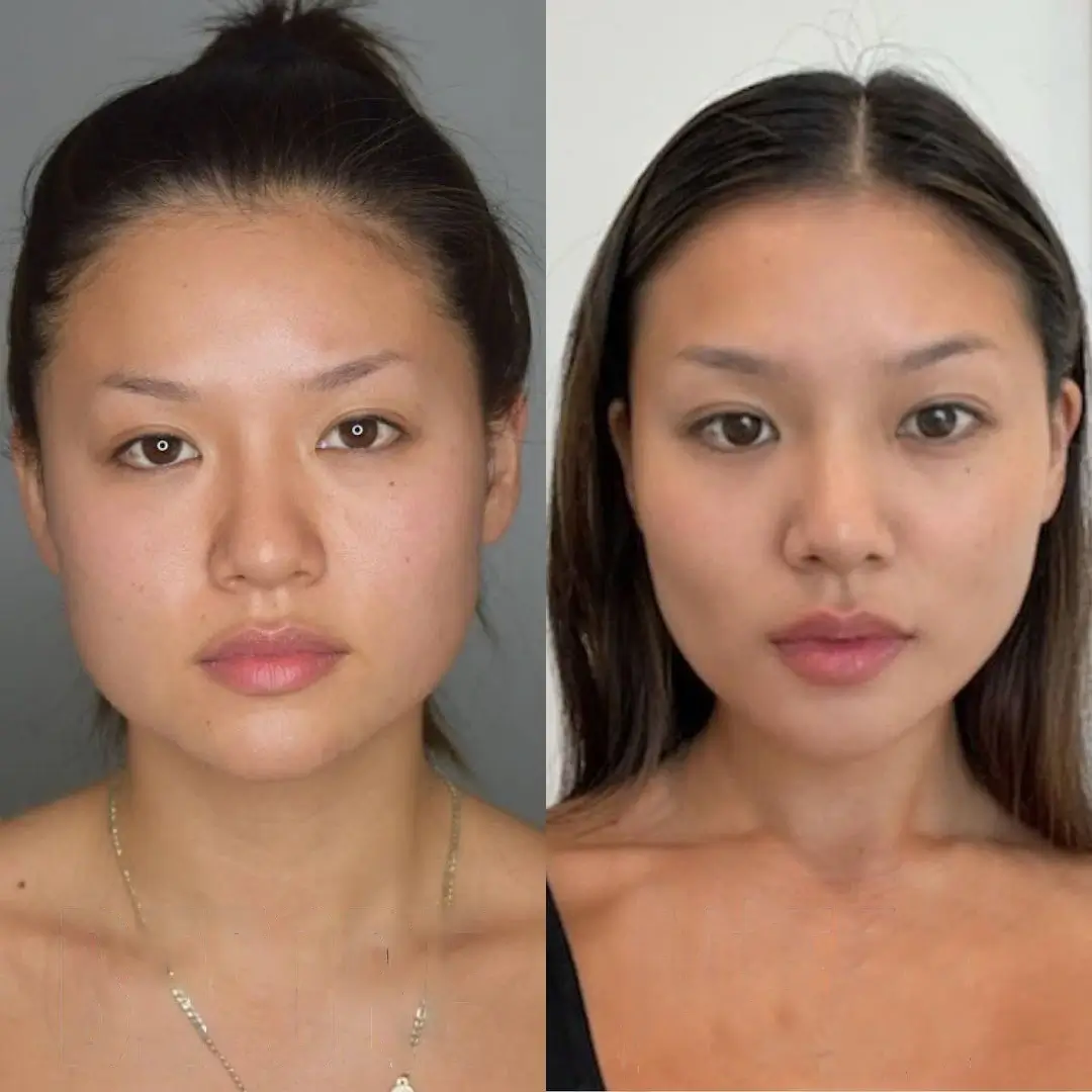 How Safe is Buccal fat removal Surgery in dubai?