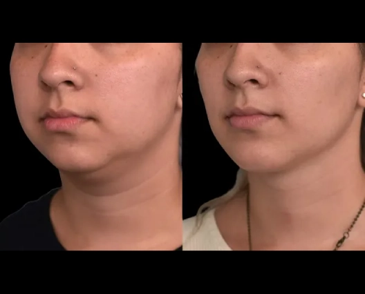 Best Skincare Routine After Double chin removal Surgery in dubai