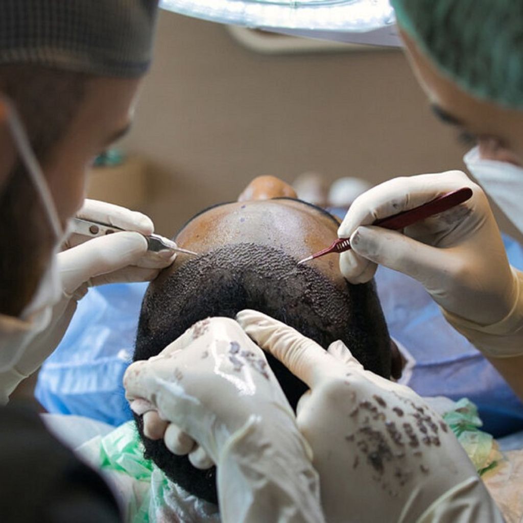 The Science Behind Hair Transplants: How It Really Works