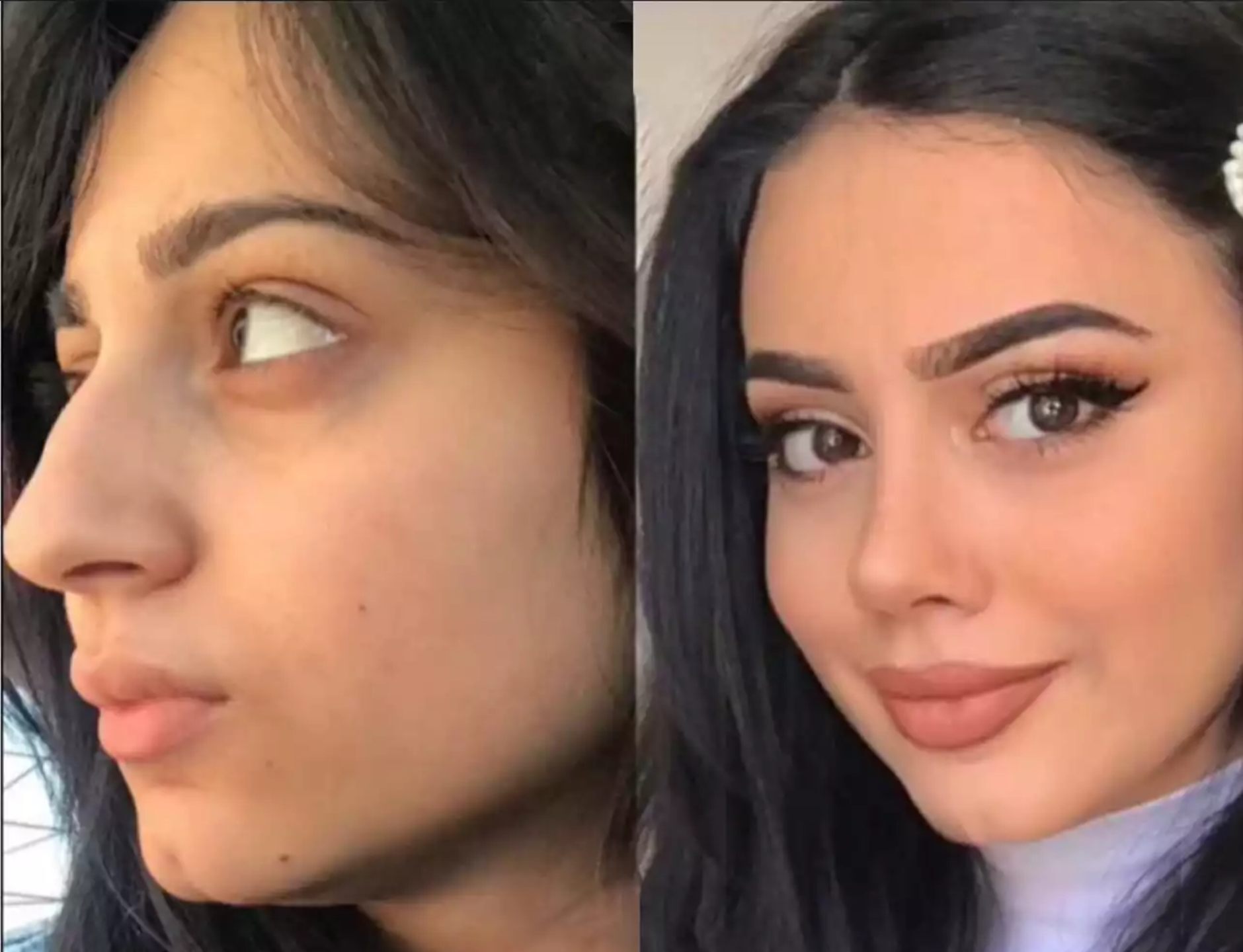 Best Rhinoplasty Surgeons in Dubai for Subtle Cosmetic Enhancements