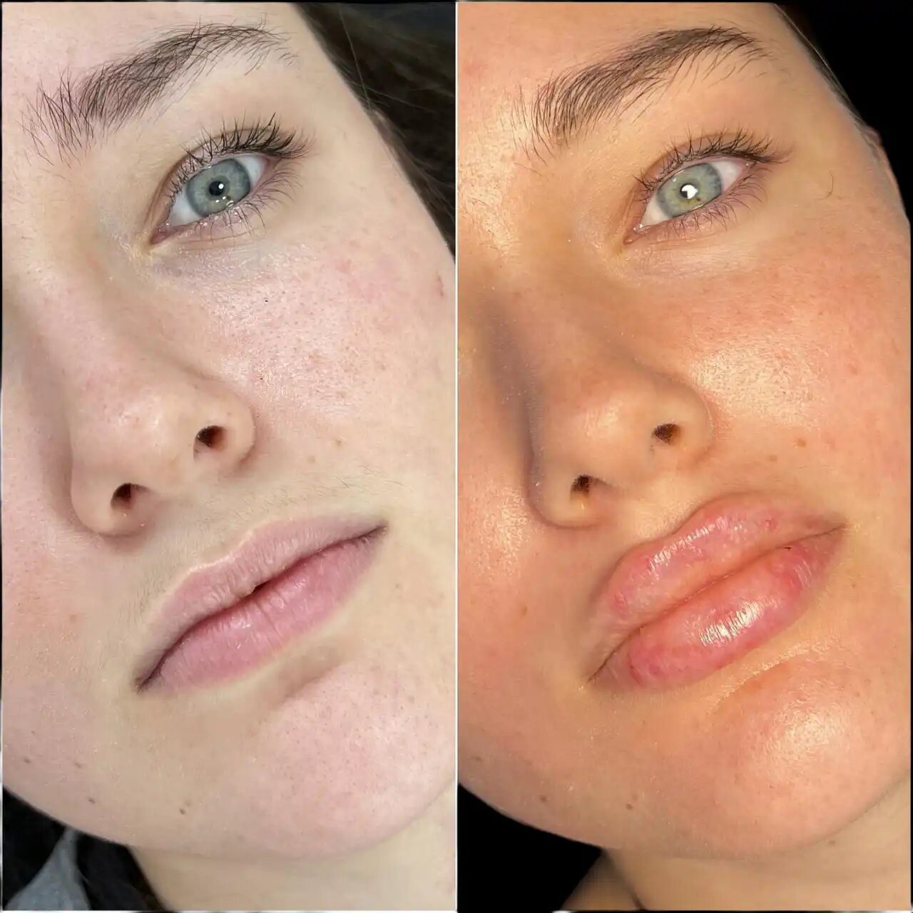 Best Plastic Surgeon in dubai:Enhance Your Look with Fillers