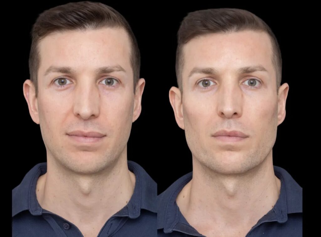 How the Best Cheek Fillers in Dubai Achieve Stunning, Result