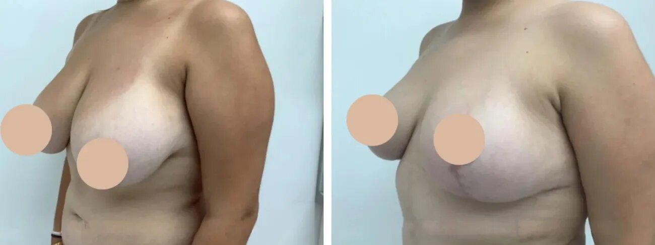 Exploring the Cost Factors of Breast Lift Surgery in dubai