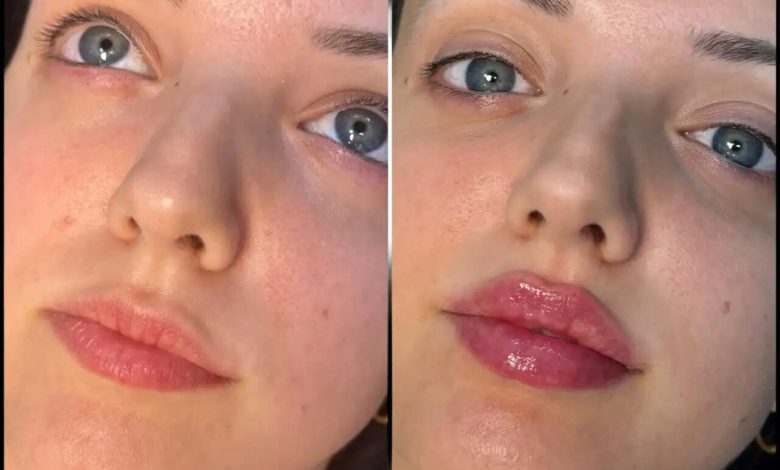 What Sets the Best Plastic Surgeons in dubai Apart in Filler