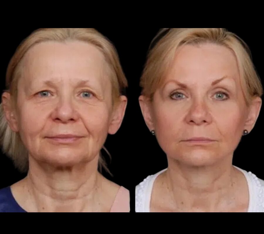 The Safety of Under Eye Fillers in Dubai: Key Facts