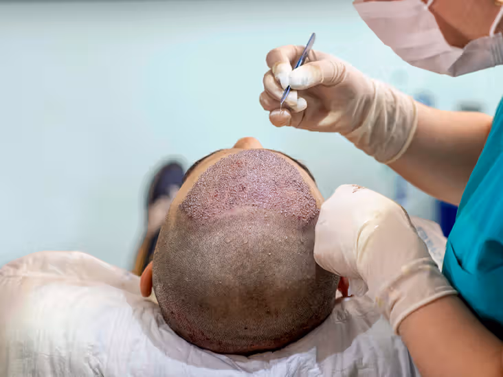 Hair Transplant Clinic in Delhi: Everything You Need to Know