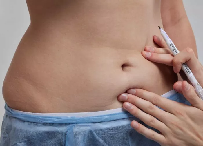 Is Tummy Tuck Recovery Time Predictable?