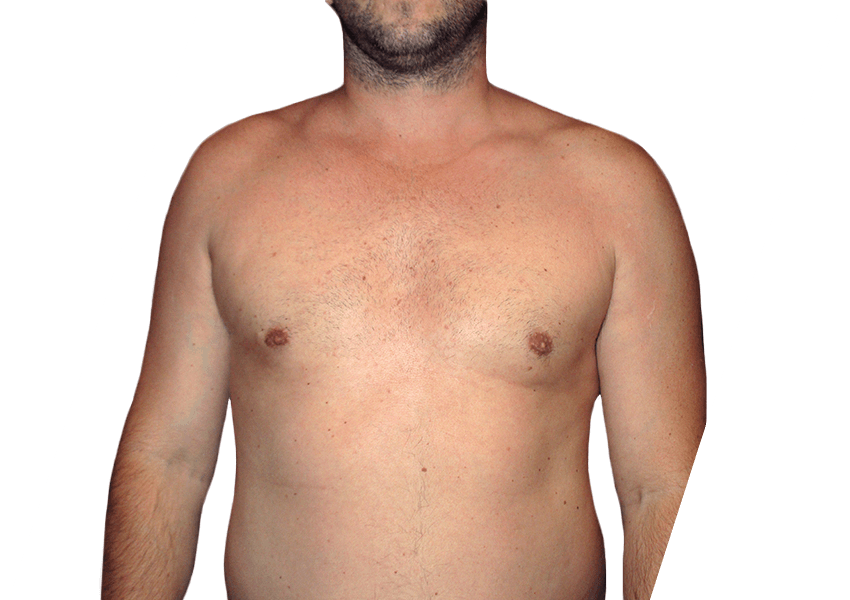 What is the Difference Between Laser Liposuction and CoolSculpting?