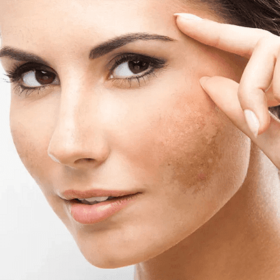 Melasma Treatment Options You Can Trust