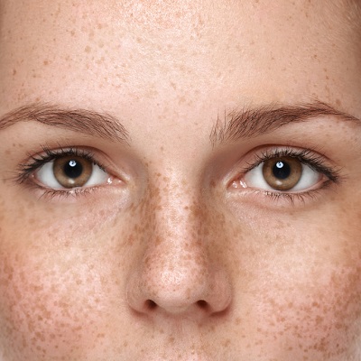 Fractional RF Microneedling: A Natural Skin Care Treatment