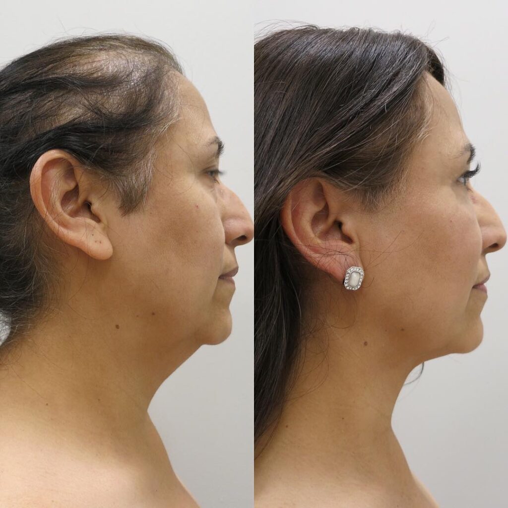 How Long Does Recovery from a Neck Lift Take?