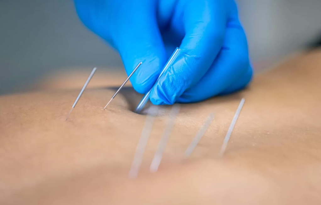 Discover the Power of Dry Needles at Dynasty Clinic