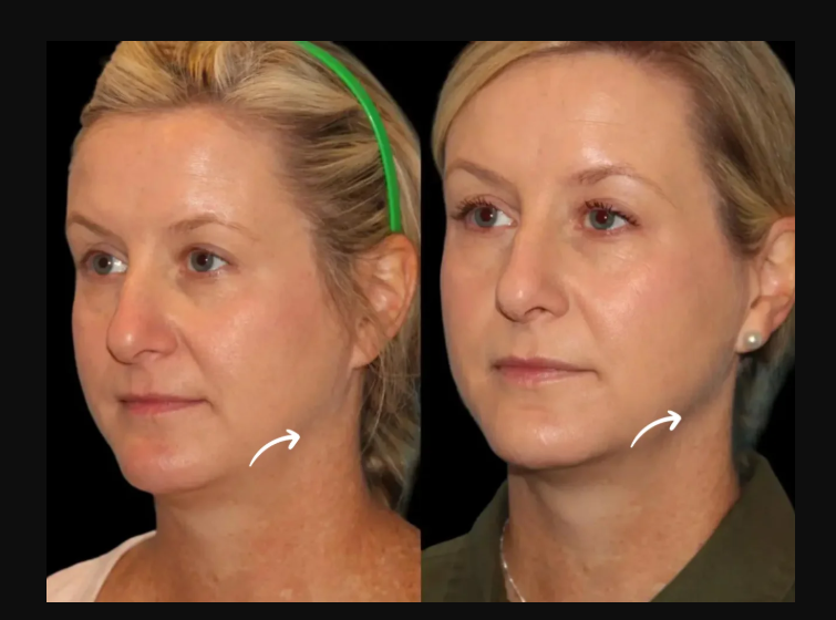 What to Expect from Sculptra Fillers by Dubais Best Doctors