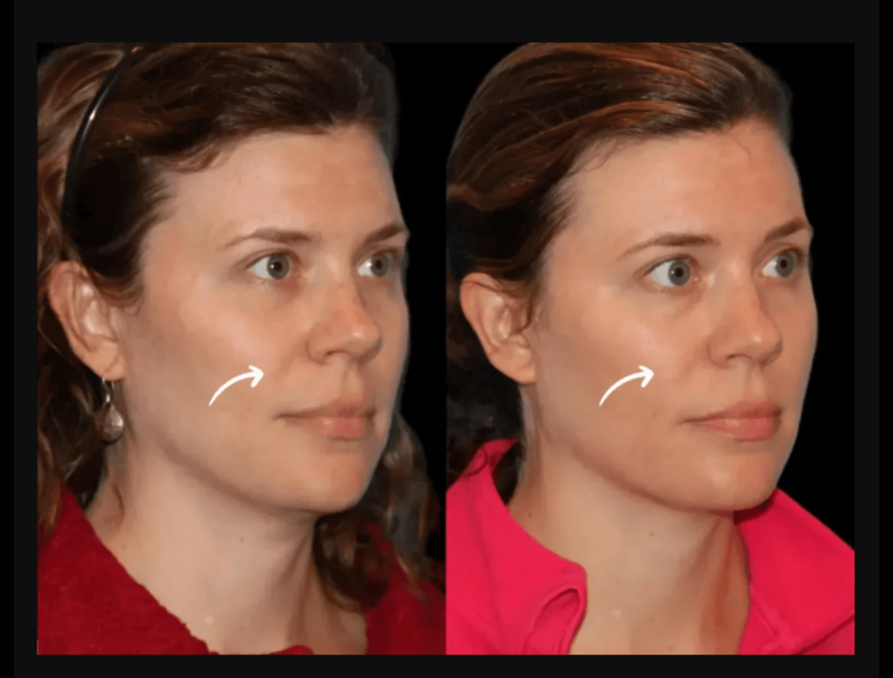 Can Sculptra Fillers Treatment in Dubai Replace Surgery?