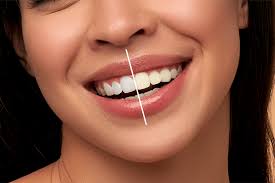 Teeth Whitening Costs You Must Know