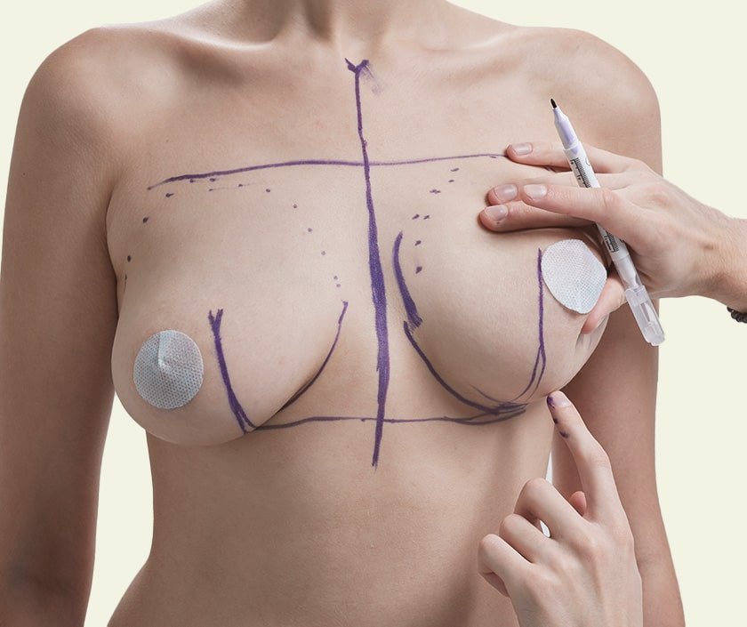 The Healing Process Following a Modern Breast Lift