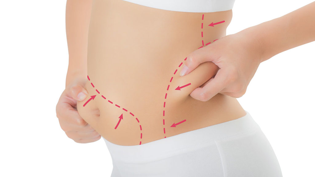 Tummy Tuck: Enhancing Body Symmetry