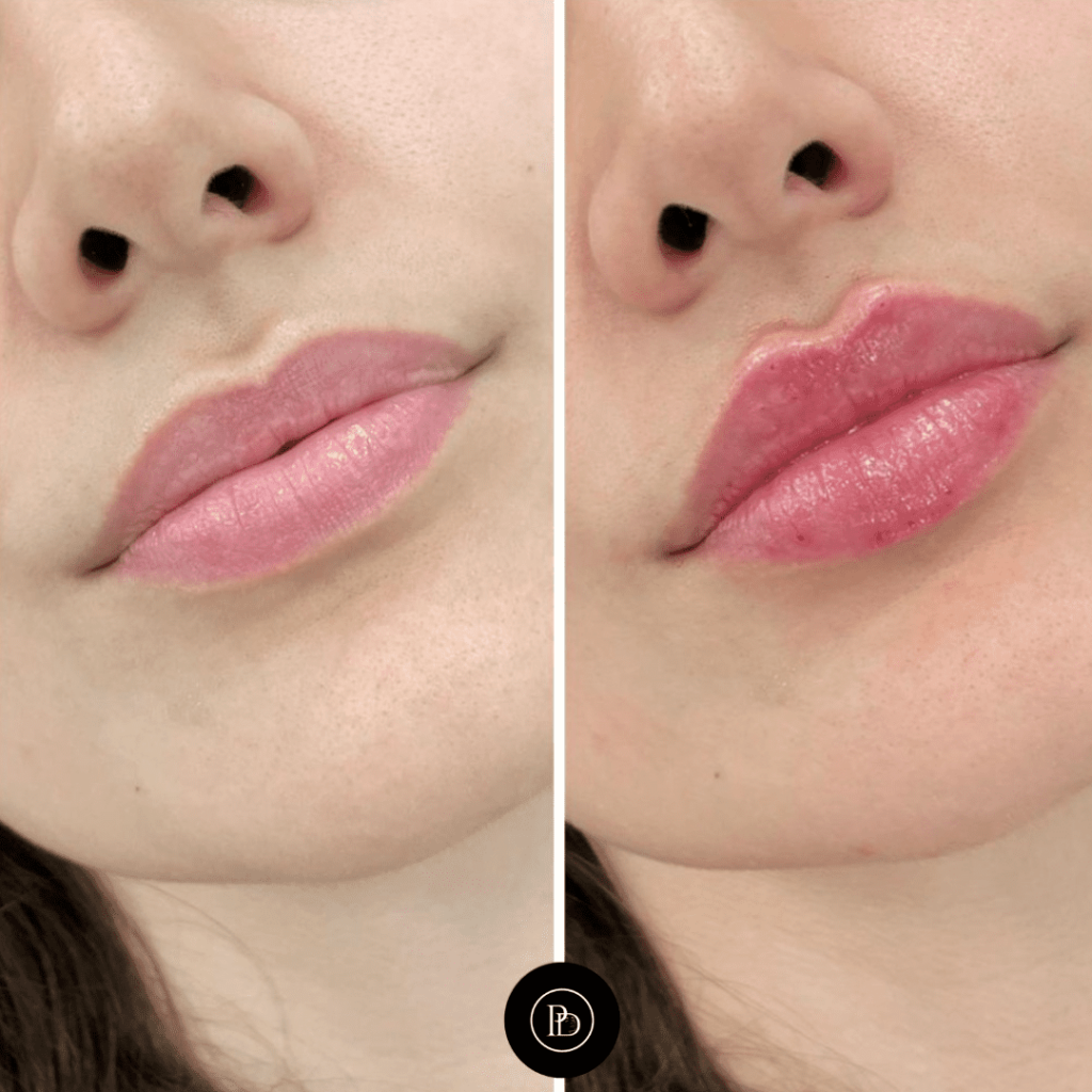 Sculpting the Chin with Juvederm treatment in Dubai