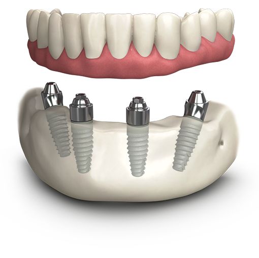 What Are the Benefits of All on 4 Dental Implants?