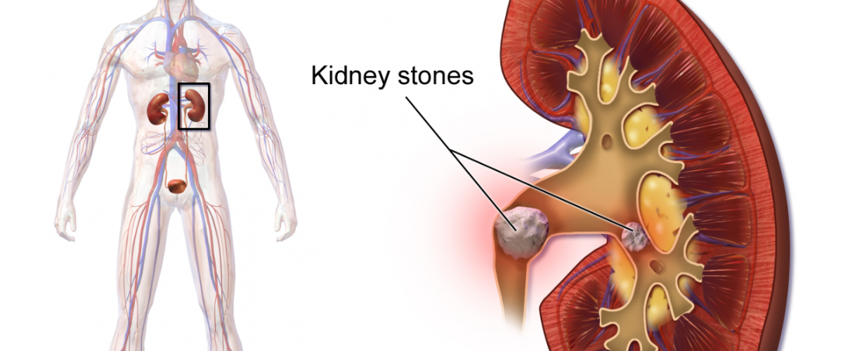 Kidney Stone Laser Treatment in Noida