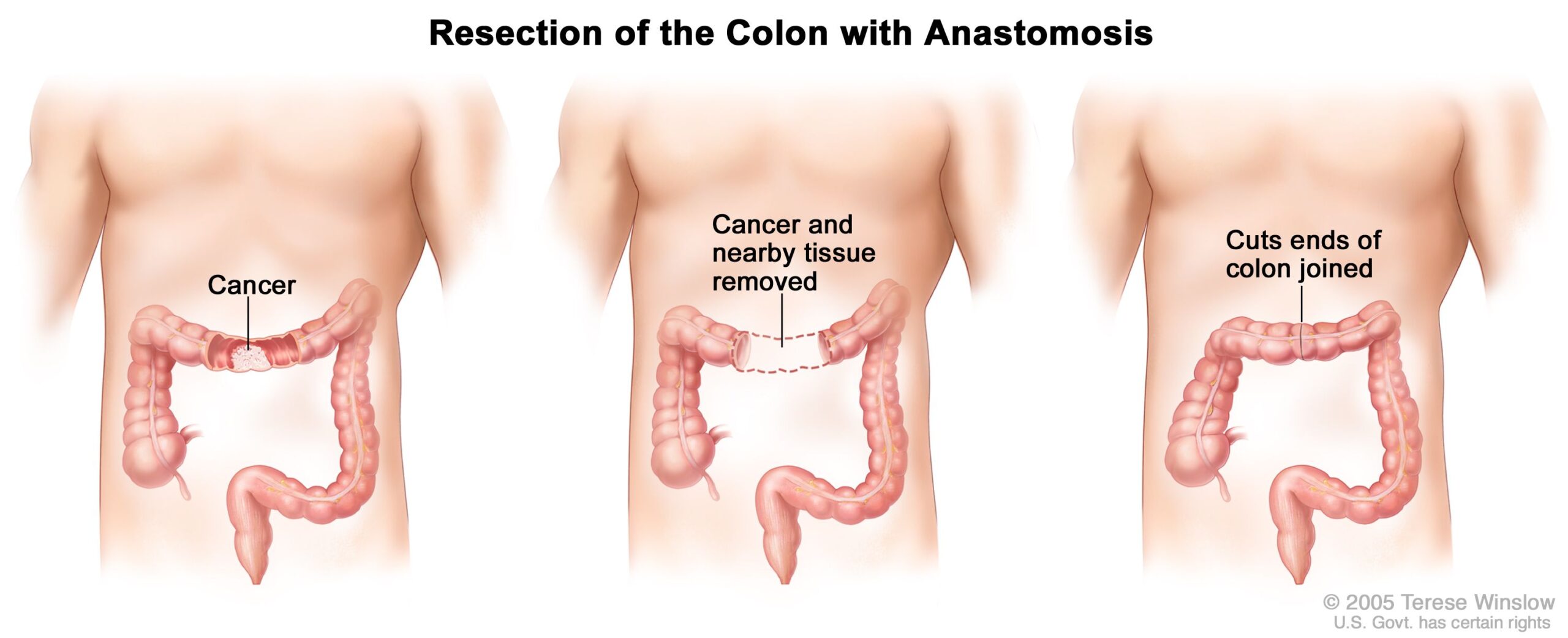 How Much Does Colon Cancer Treatment Cost in India?