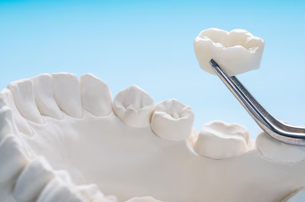 The Pros and Cons of Dental Crowns