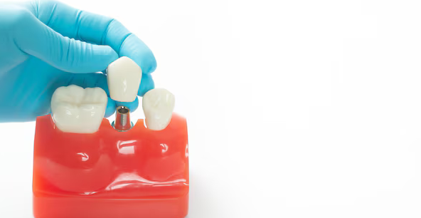 Why Dental Implants Are Essential for Replacing Lost Teeth