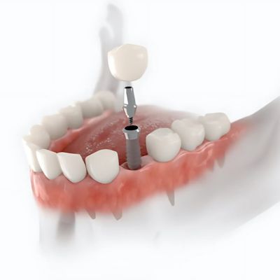 What Is the Cost Difference Between Dental Implants and Dentures?