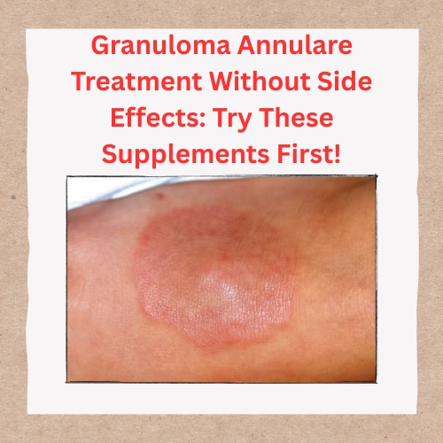 New PostGranuloma Annulare Treatment Without Side Effects: T