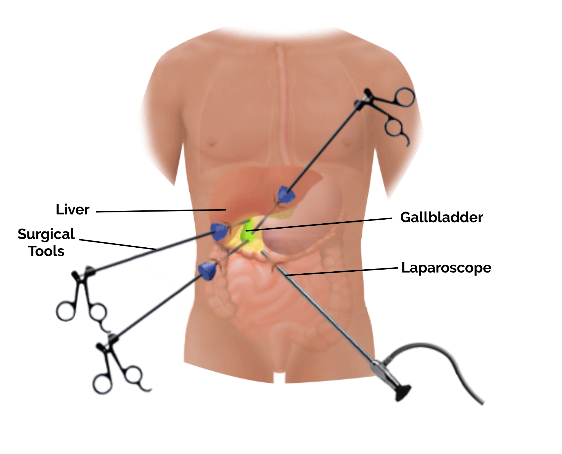 Do You Need Gallbladder Surgery in Singapore?