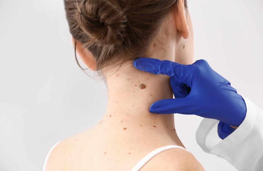 Say Goodbye to Skin Tags: Expert Skin Tag Removal