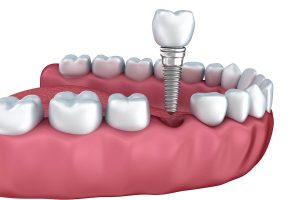The Life-Changing Benefits of Dental Implants for the Elder